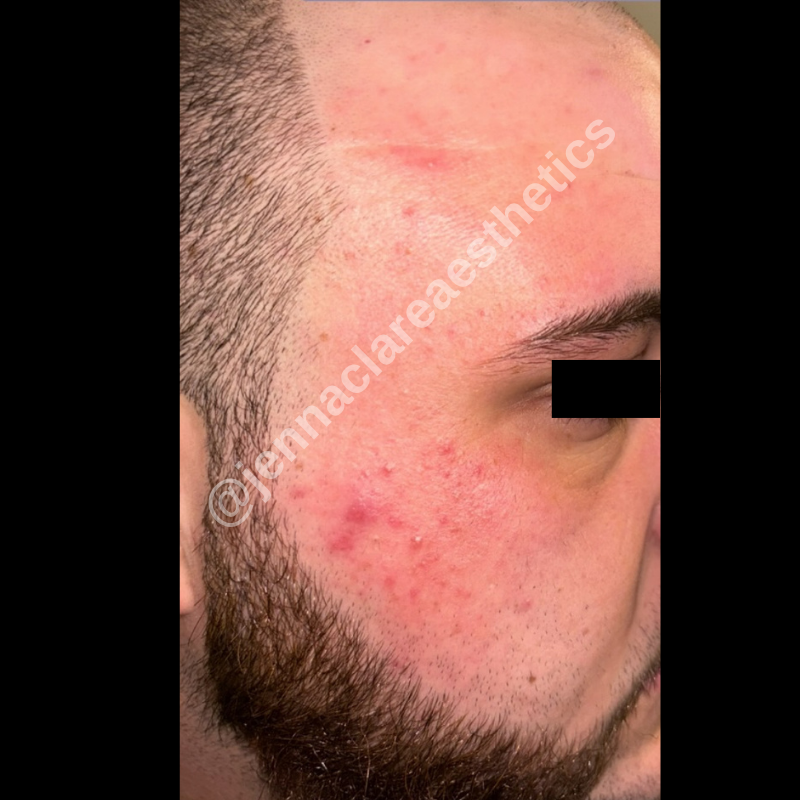 Before treatment