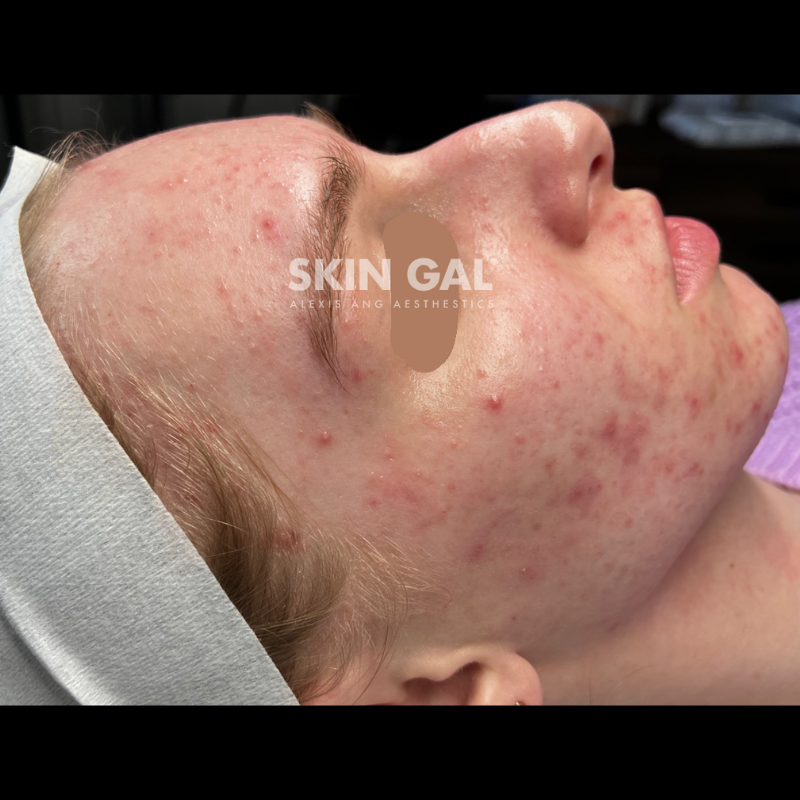 Before treatment