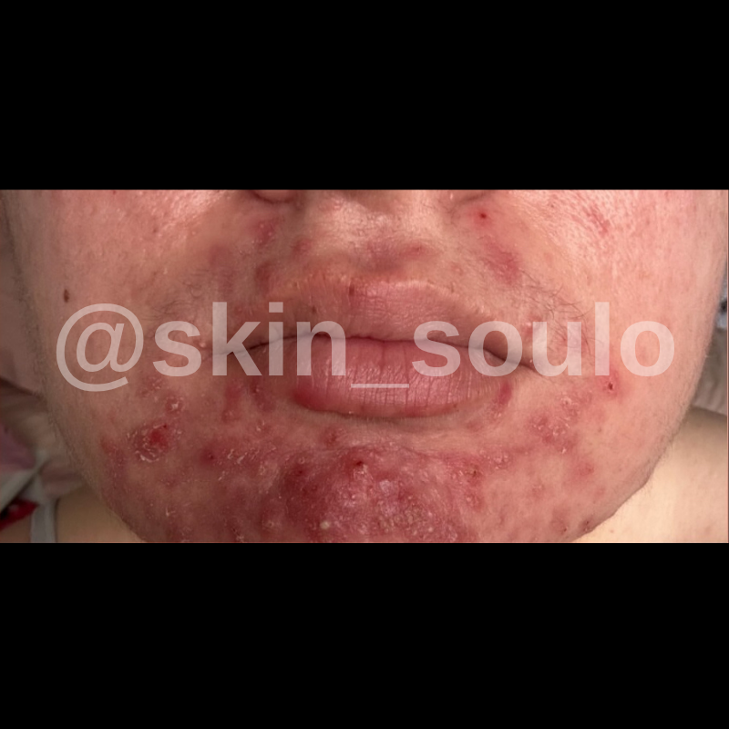 Before treatment