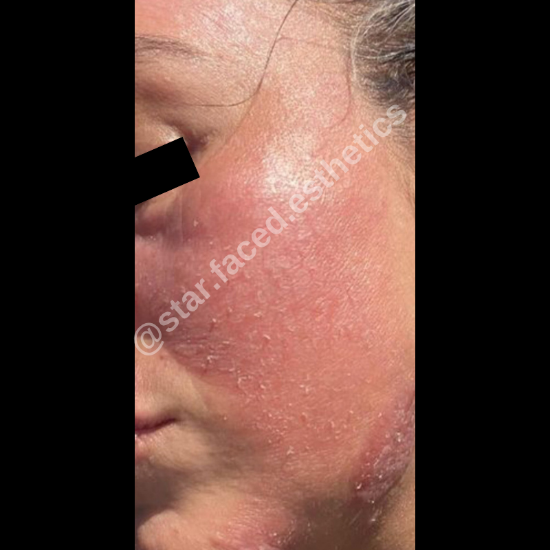 Before treatment