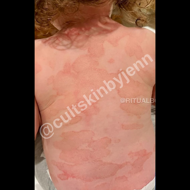 Before treatment