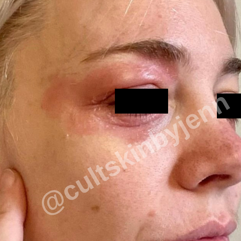 Before treatment