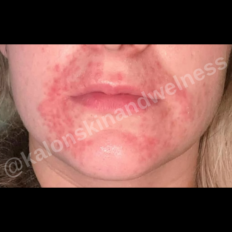 Before treatment
