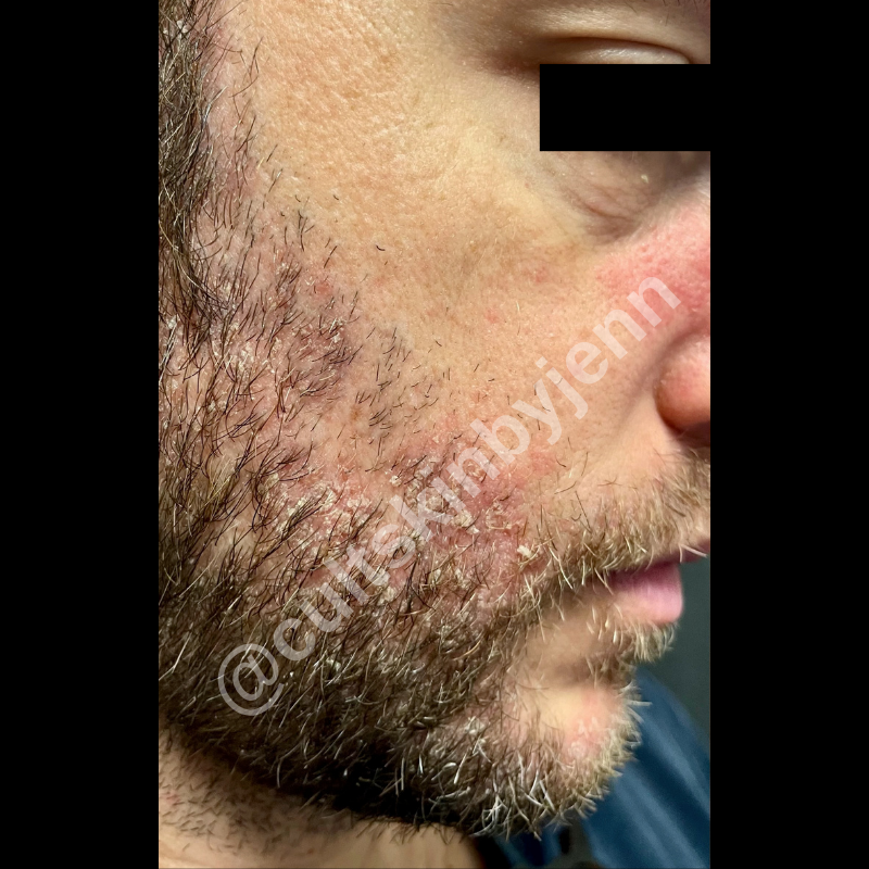 Before treatment