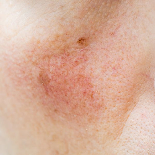 Dehydrated Skin