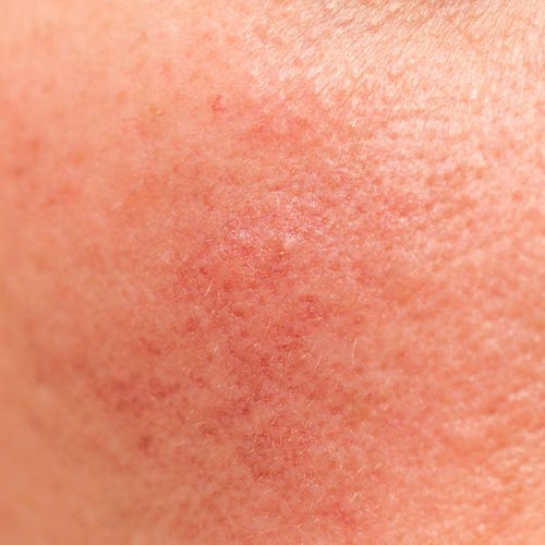 Sensitive Skin