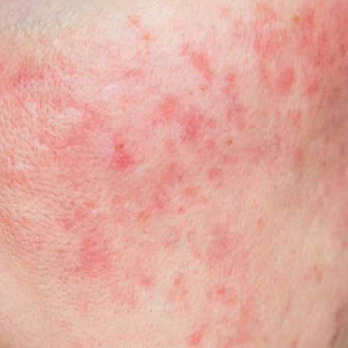 Irritated Skin