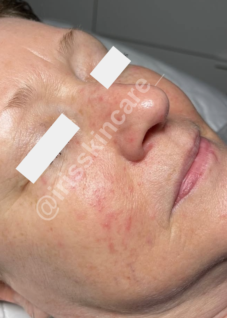 Before treatment