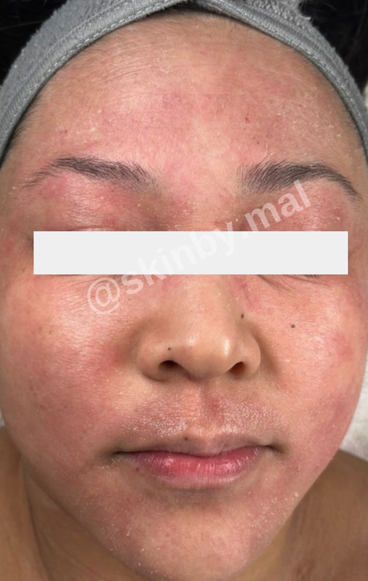 Before treatment